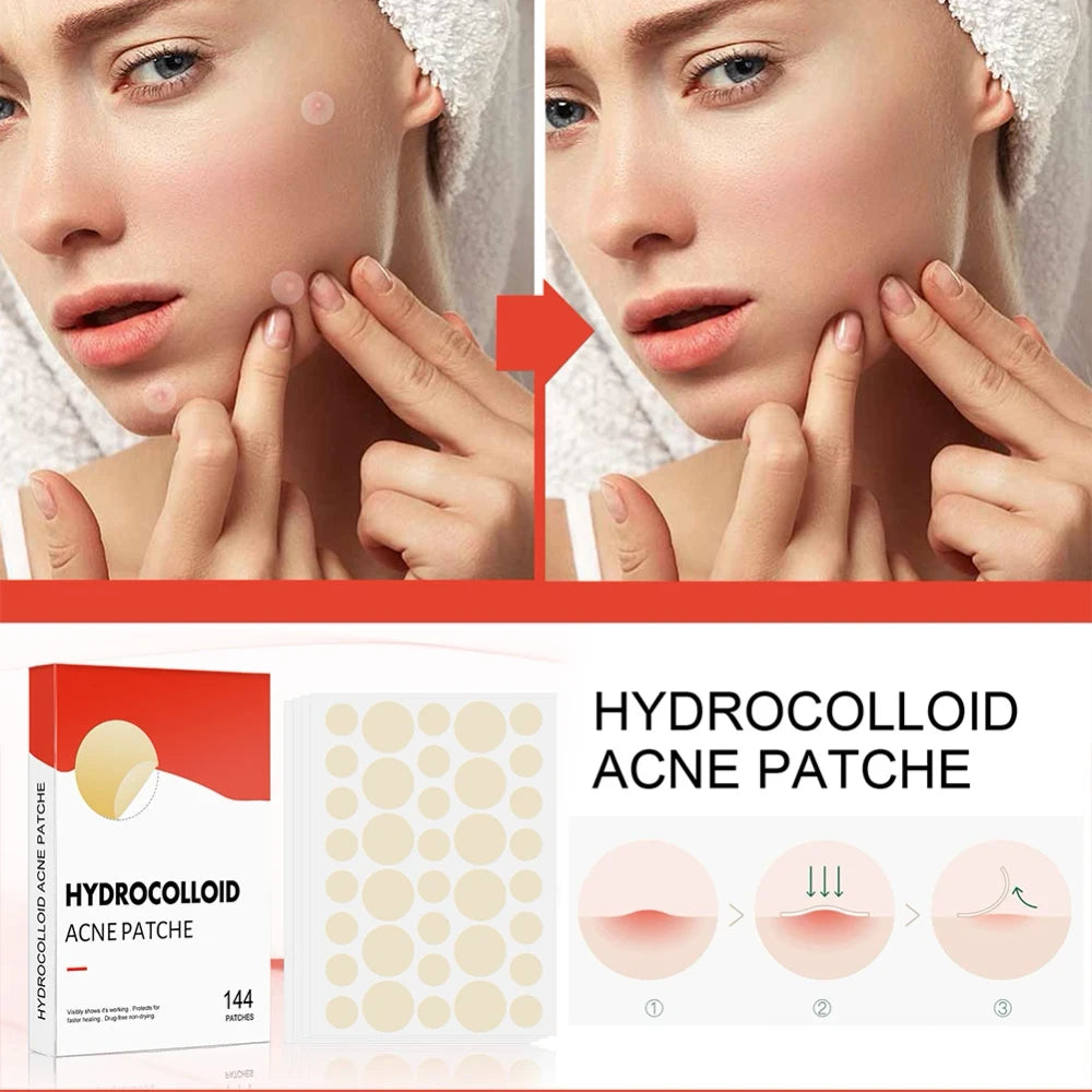 Acne Pimple Patches 144-Count
