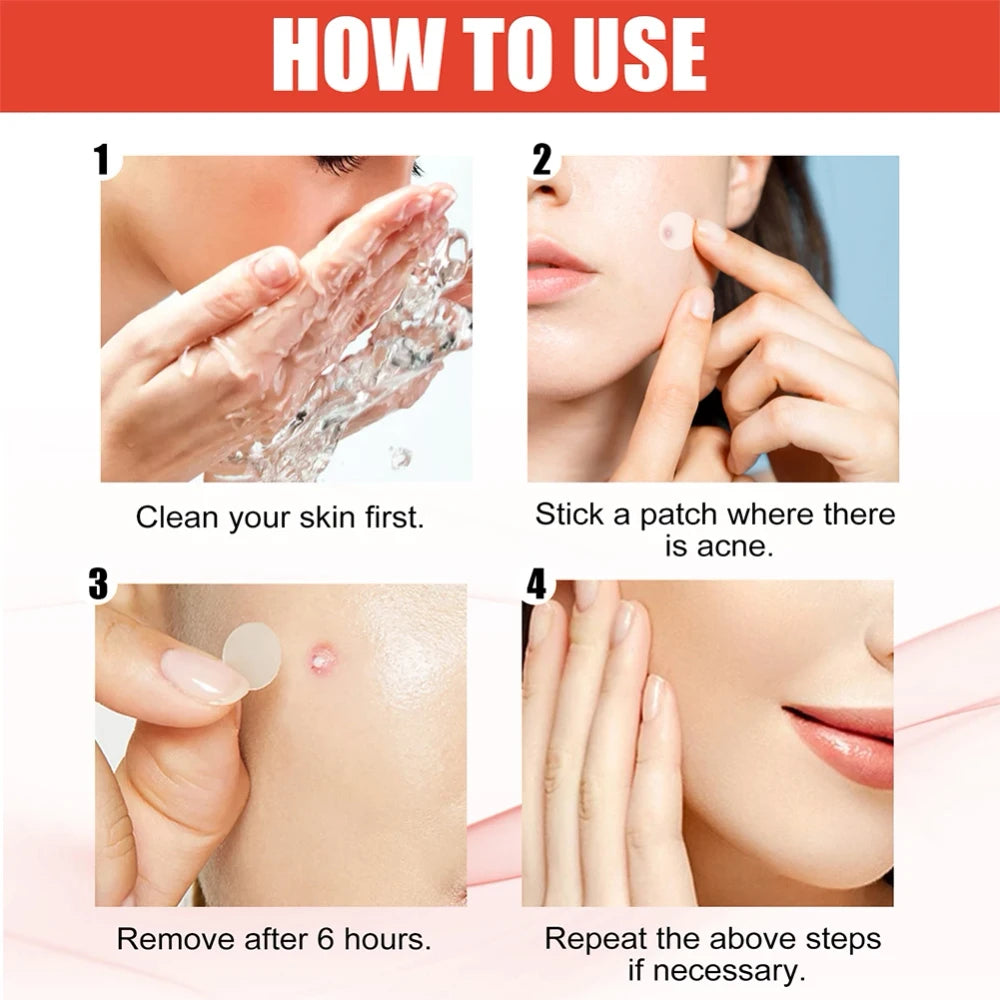 Acne Pimple Patches 144-Count